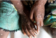 Ghana Health Service records Mpox case in Greater Accra Region